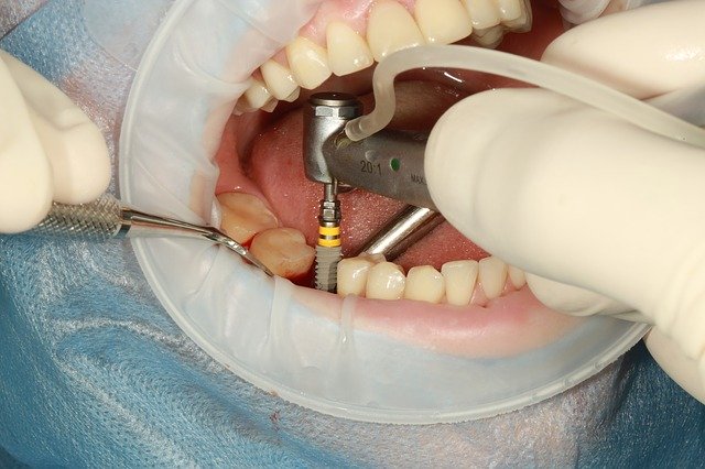 Free download Dental Implant -  free photo or picture to be edited with GIMP online image editor