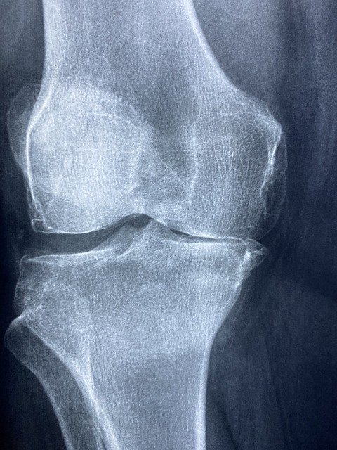 Free download knee x rays arthritis skeleton free picture to be edited with GIMP free online image editor