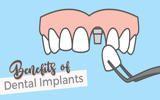 Benefits of Dental Implants  from Chrome web store to be run with OffiDocs Chromium online