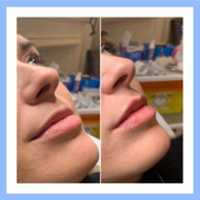 Free download Lip Filler Treatment London free photo or picture to be edited with GIMP online image editor