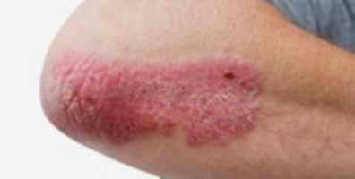 Muat turun percuma gambar atau gambar percuma Plaque Psoriasis 2 untuk diedit dengan editor imej dalam talian GIMP