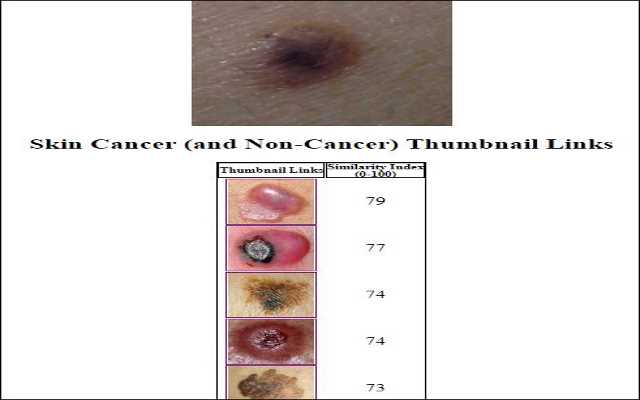 Skin Cancer Image Search  from Chrome web store to be run with OffiDocs Chromium online