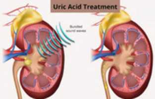 Free download Uric Acid Treatment free photo or picture to be edited with GIMP online image editor